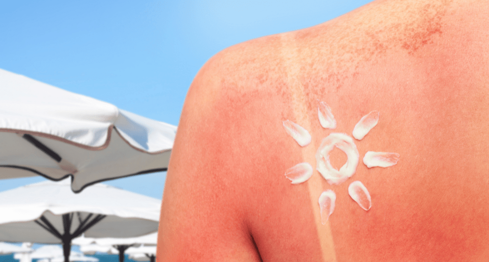 The "Fake Shade" Problem: Why You Still Got Sunburned Under Your Umbrella - Handy Beach Goods