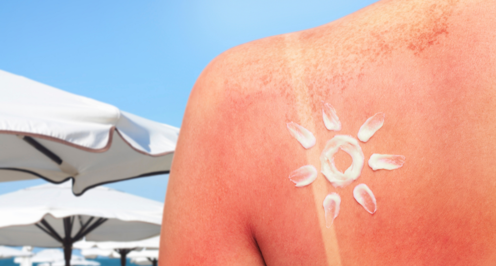 The "Fake Shade" Problem: Why You Still Got Sunburned Under Your Umbrella